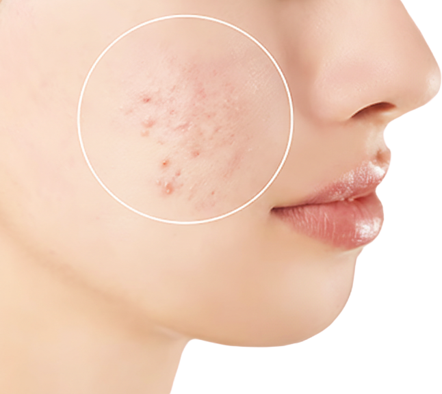 Acne Treatment
