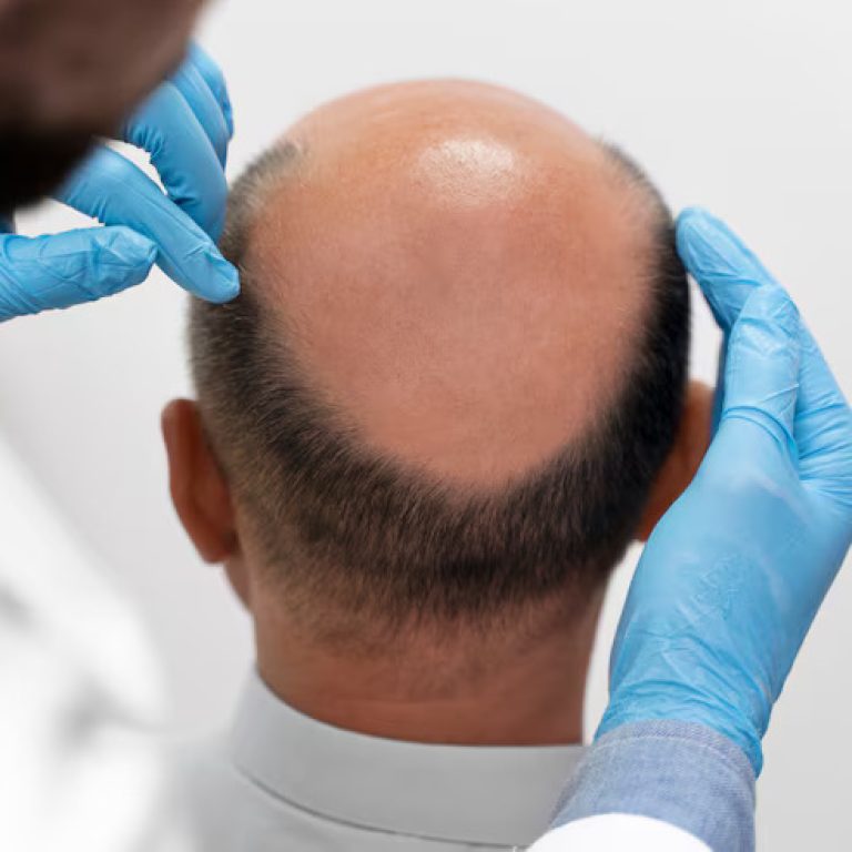 man-going-through-follicular-unit-extraction-process_23-2149106288 (1)