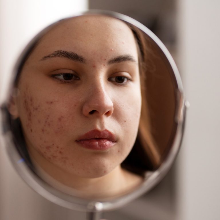 person-dealing-with-rosacea_23-2150478609