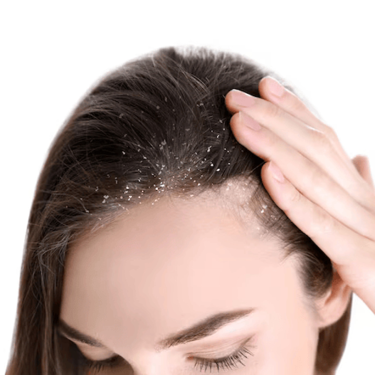 woman-with-dandruff-her-hair-white-background-closeup_495423-30843